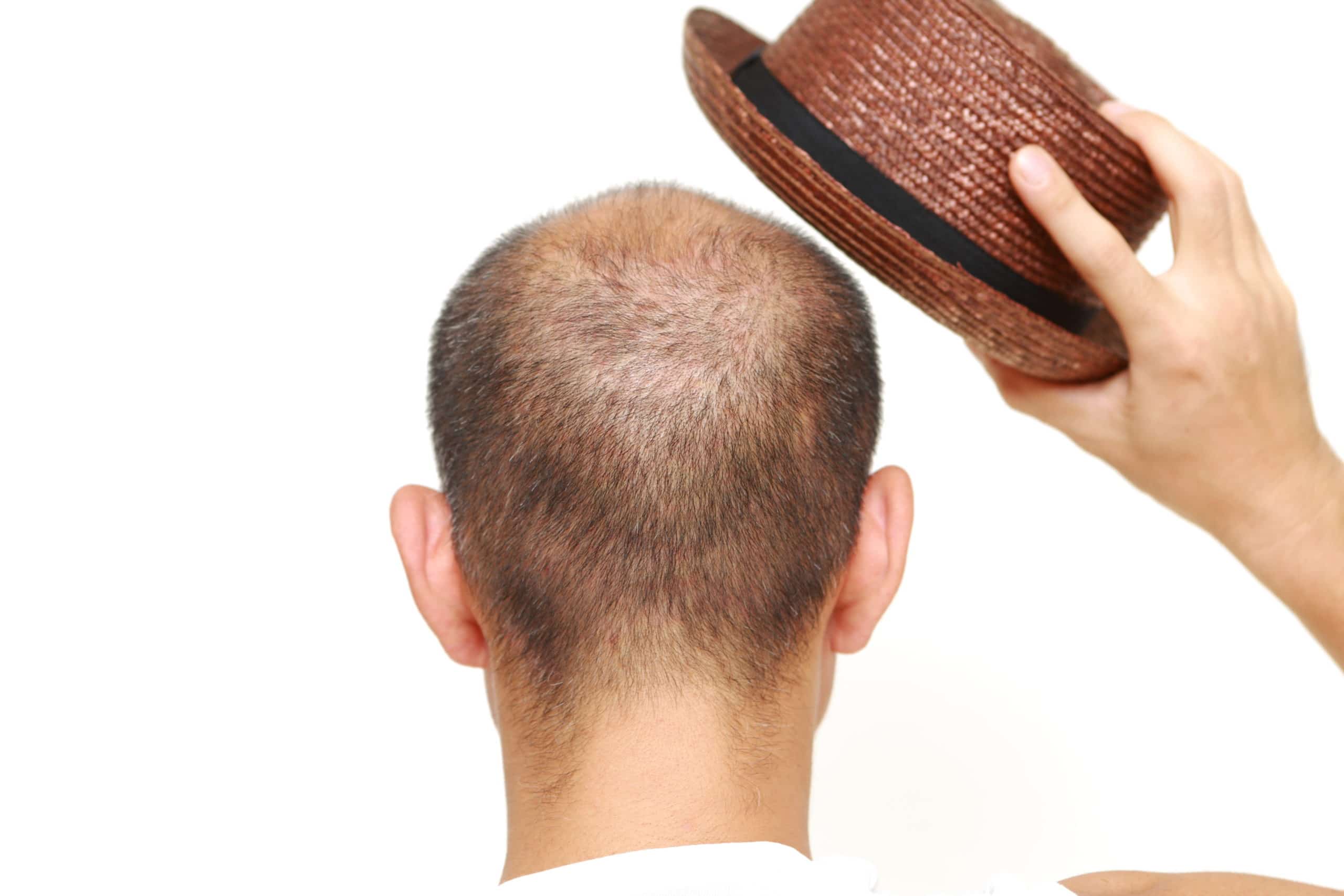 Is it Conceivable that Wearing a Cap Might Cause Hair Loss?